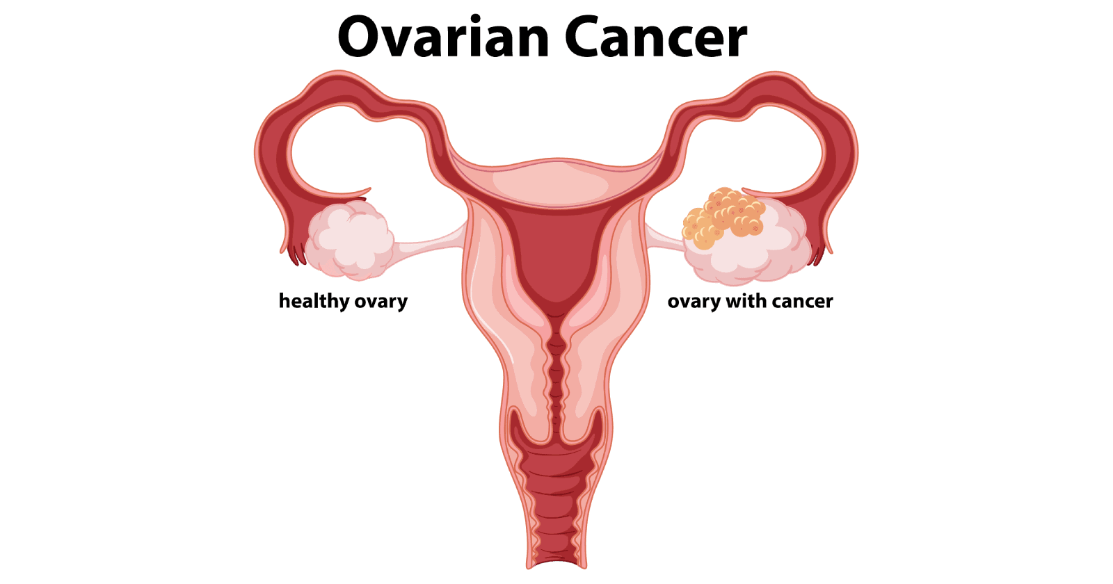 best ovarian cancer surgeon in Delhi