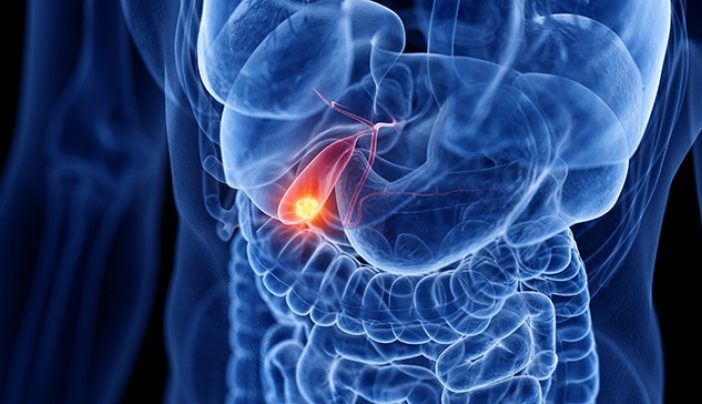 gallbladder cancer treatment in Delhi