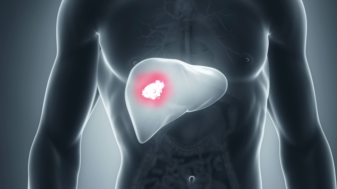 Image related to liver cancer symptoms